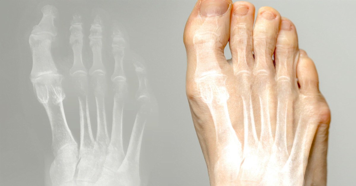 Hallux valgus Behandlung – Zehenspreizer und Schuhwerk