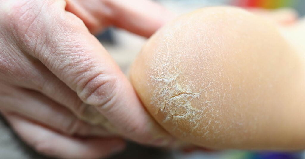 Fersensprünge – Risse und Spalten in der Haut der Ferse