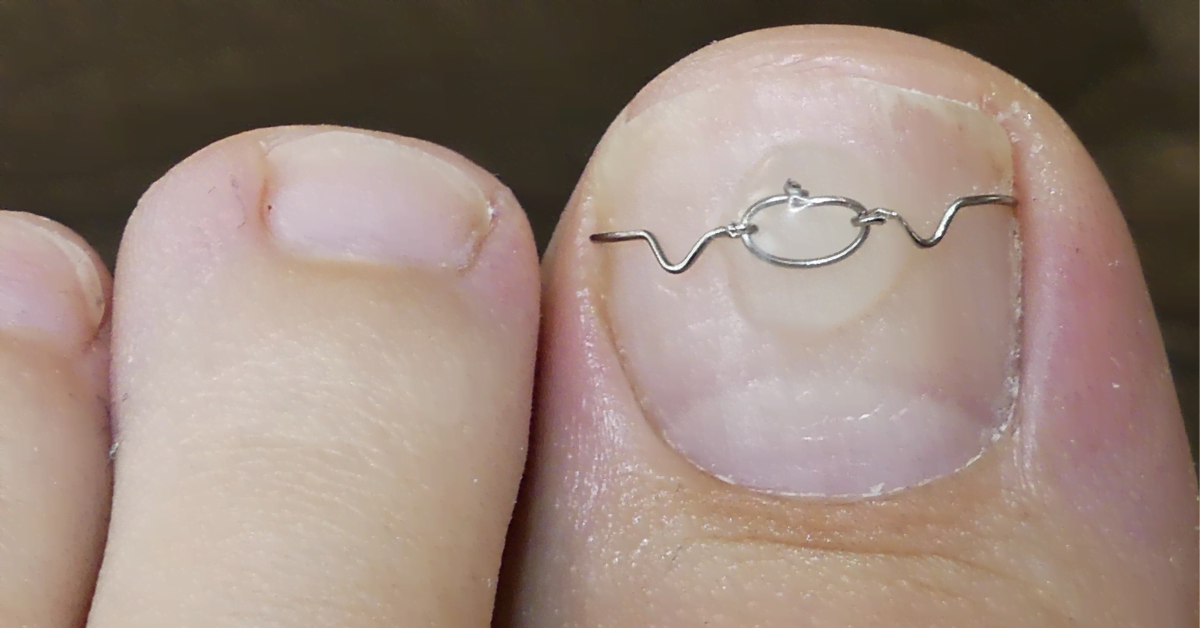 Eingewachsener Nagel – Behandlung und Vorbeugung