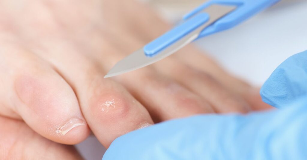 Hühnerauge – Korn am Fuß