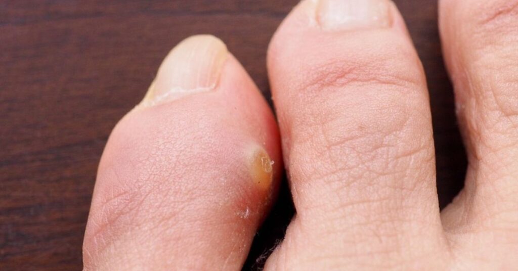 Hühnerauge Behandlung – Pediküre und Vorbeugung